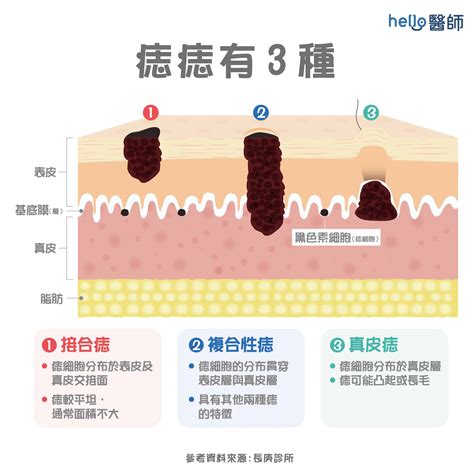 全身痣|為什麼臉上的痣越來越多？皮膚科醫師解析長痣原因、。